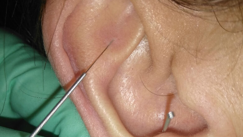 Agopuntura nel trattamento della SLA: implicazioni sistemiche e oro-faringee