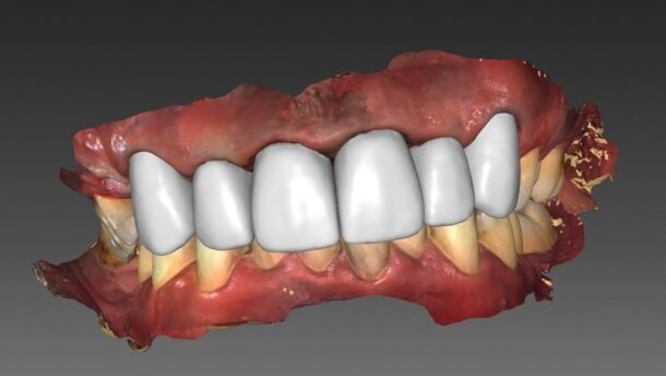 Leczenie kompleksowe z użyciem skanera wewnątrzustnego i technologii CAD/CAM – opis przypadku