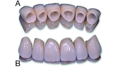 FujiCEM Evolve, un ciment verre ionomère modifié par adjonction de résine