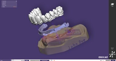 Exocad launches PartialCAD 3.3 Chemnitz with split denture workflow