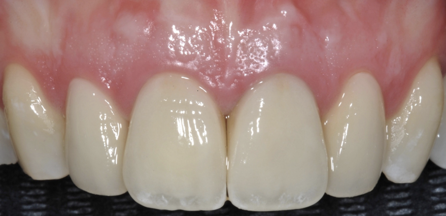 Fig. 14-16 - Il caso ultimato.