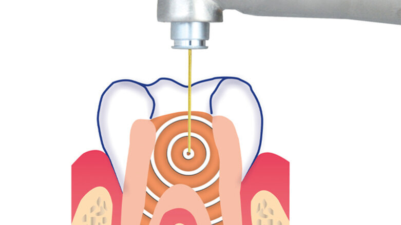 SSP/SWEEPS endodoncie se SkyPulse Er:YAG laserem