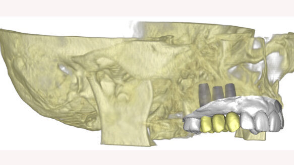 Materialise Dental is celebrating 20 years of 3-D Digital Dentistry