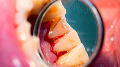 Parodontite legata a un tasso di mortalità più elevato nei pazienti con cirrosi epatica