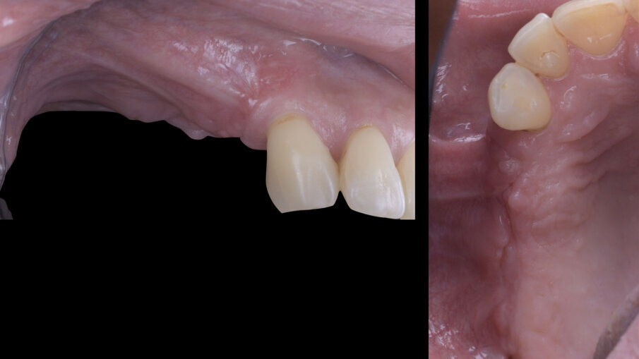Fig. 8 - Guarigione a 6 mesi.
