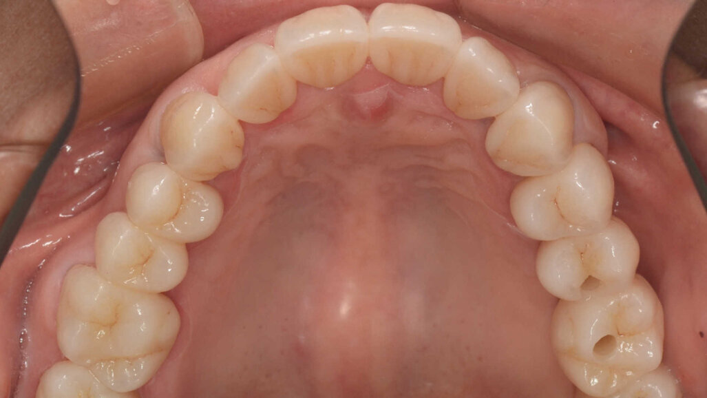 Encore un peu plus près de la nature : concepts occlusaux et esthétique raffinée en dentisterie numérique