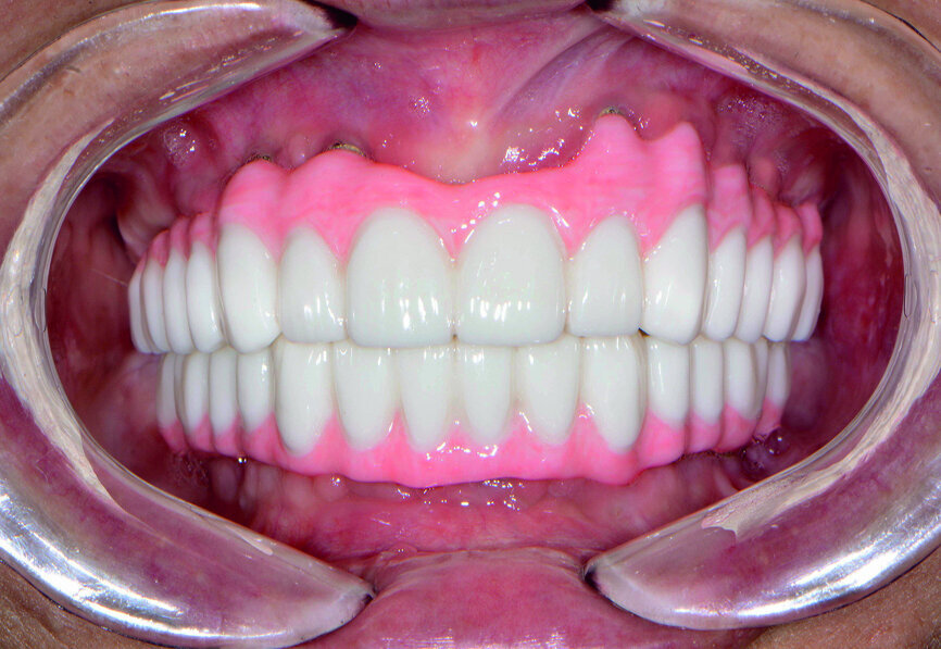 Fig. 22: Post-op retracted closedbite
view.