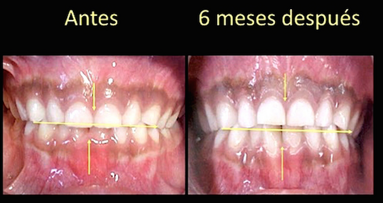 Evolución del tratamiento miofuncional postural con los sistemas de MRC (2)