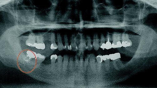 Ritrovamento di corpi estranei durante un trattamento odontoiatrico di routine