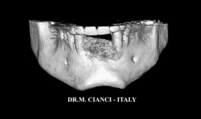 Fig. 4 - Immagine 3D della mandibola post-GBR.