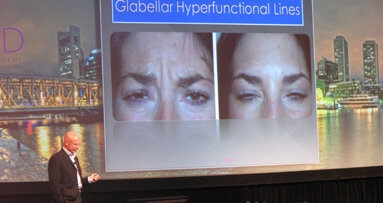 Botox can optimize the cosmetic appeal of dental implant surgery, expert says