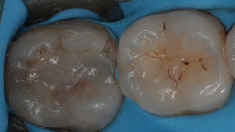 Fig. 24_Isolamento del campo operatorio.