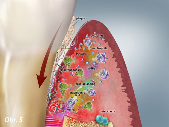 Obr. 5: Pozdní chronická léze – parodontální tkáň: Apikální migrace patogenních mikroorganismů jako je P. gingivalis, další rozpad periodontálních vazů a zvýšená tvorba ulcerací na epiteliální výstelce, závažná resorpce kosti. Buněčná úroveň: Více neutrofilů, makrofágů a dalších. Biochemická úroveň: Zvýšená hladina prozánětlivých cytokinů reguluje uvolnění MMP (podílejících se na kostní resorpci a degradaci kolagenu). Kolagenové fragmenty poskytují výživu patogenním mikroorganismům. Arachidonová kyselina pokračuje v produkci prostaglandinu.