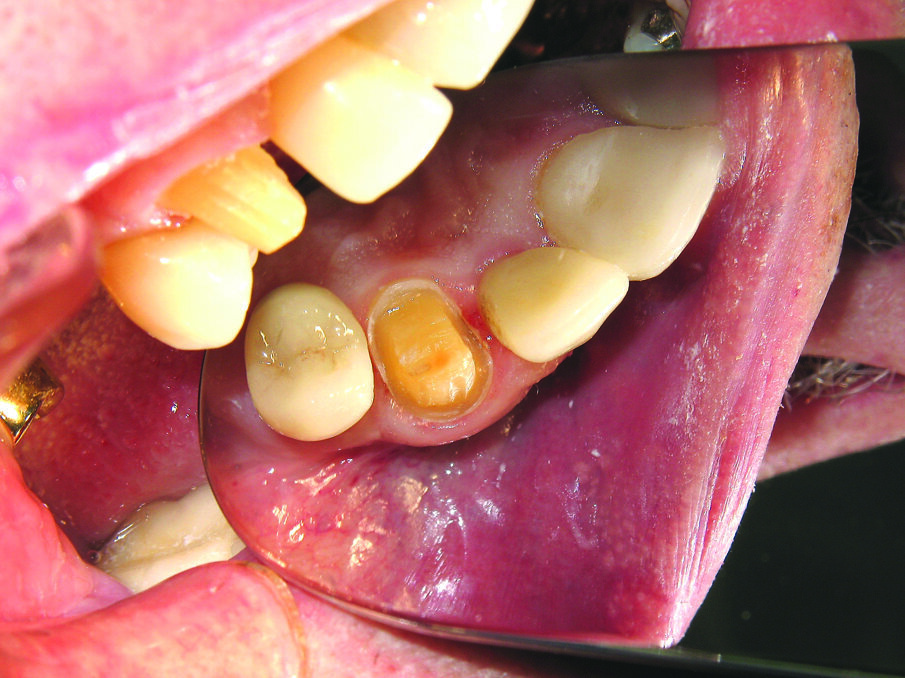 Fig. 1. Prepared tooth #6