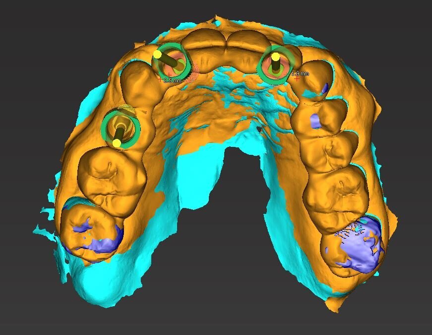 Fig. 14_Visione palatale del wax-up completo in marrone, sovrapposto alla visione ossea in azzurro con gli elementi sottostanti in viola. L’impianto in posizione 1.5 anche se progettato non è stato inserito preferendo un progetto protesico convenzionale con il collegamento a ponte degli elementi limitrofi.