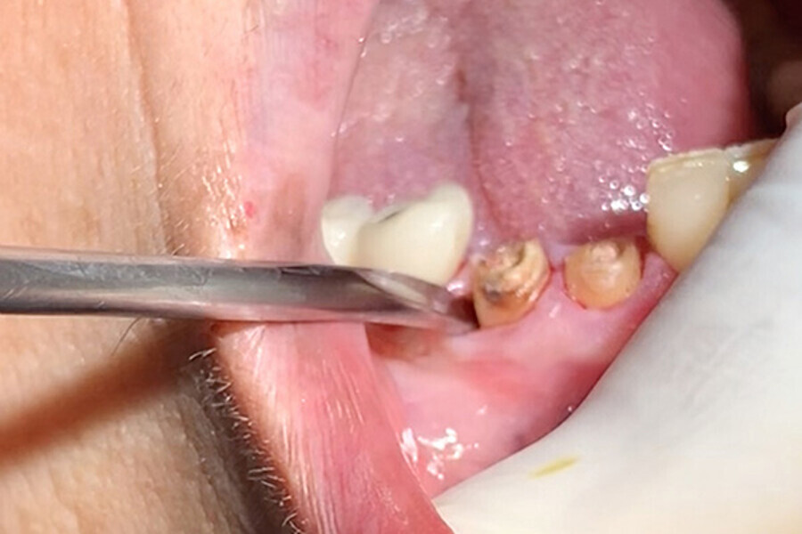 Figs. 5. Uso de Botador fino para complementar la luxación.