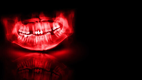 Primeiro estudo longitudinal investiga a relação entre saúde bucal e doença renal