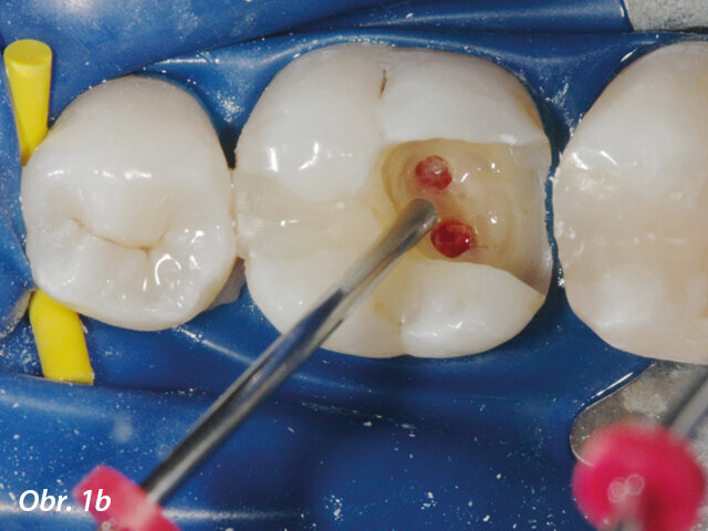 Částečná pulpotomie