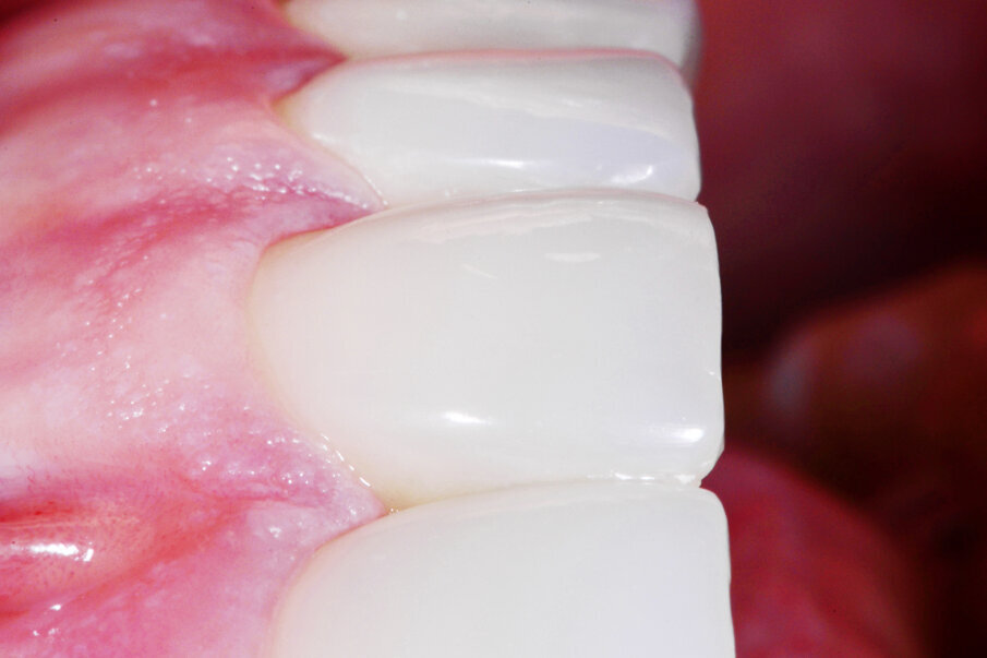 Fig. 11: No visible transitions to the tooth substance