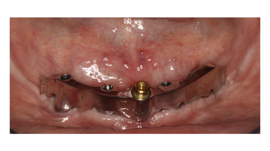 Fig. 11: Telescopic bar with retentions for the secondary structure