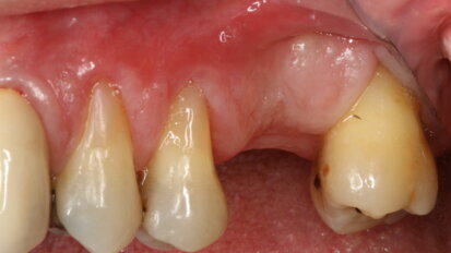 Biomateriali innovativi in implantologia: l’utilizzo di OsteoBiol Putty nel rialzo di seno transcrestale