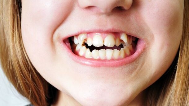 Landbouw zorgde voor scheve tanden