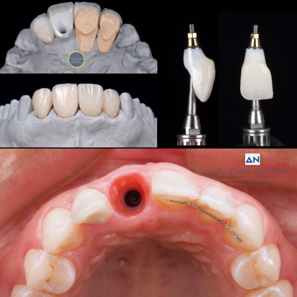 Fig. 14: The six-month post-op examination revealed healthy tissue and an aesthetic outcome.