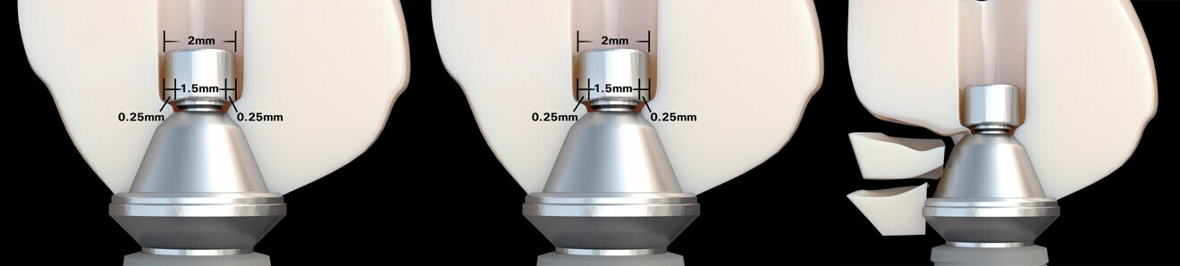 Figs. 7a–c: Dimensions of a standard multi-unit abutment screw head and the available zirconia (a & b), leading to fracture (c).
