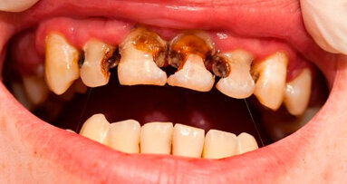 Individui con disturbi dei capelli possono essere più predisposti alla carie