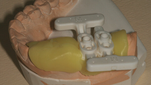 Intégration de la CFAO globale au quotidien : implantologie guidée par CEREC Guide et couronne usinée sur TiBase