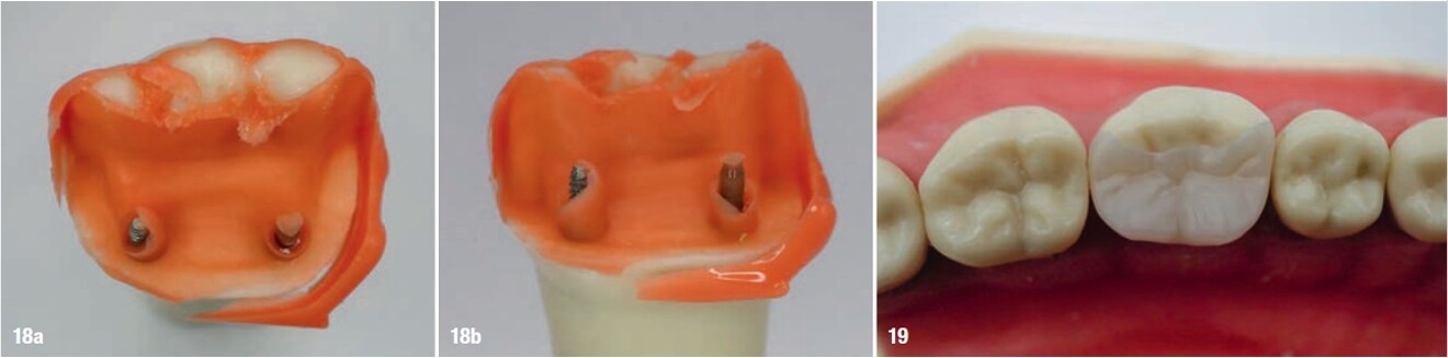 Figs. 18a & b: Fit Checker Advanced material used to assess the internal fit of the pinlay on the preparation and the dentine pins, shown in the occlusal (a) and lingual views (b). Fig. 19: Pinlay seated on the preparation after the tooth had been returned to the dentoform arch.