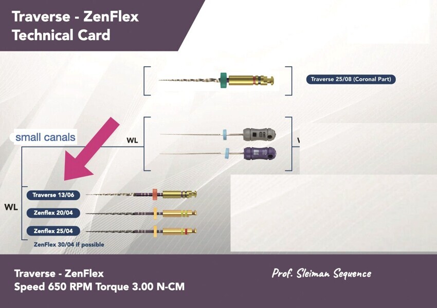Fig. 5 : La séquence Sleiman de mise en forme à l’aide des limes Traverse et ZenFlex. 