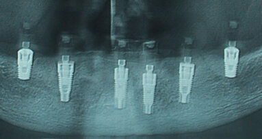Grave atrofia mandibolare riabilitata con impianti corti a carico immediato