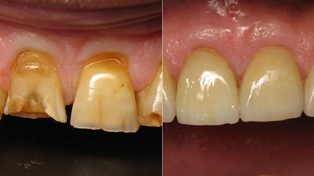 Tenet: Time inversion applied to dentistry