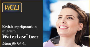 Kavitätenpräparation mit dem Laser – Schritt für Schritt