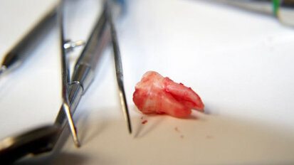 Thousands of teeth may unnecessarily be pulled for profit in UDA system