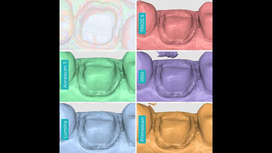 Fig. 13 – Scansione dei margini buccali e linguali. TRIOS 5 (a). Aoralscan 3 (b). Medit i900 (c). ITero Lumina (d). CEREC Primescan (e).