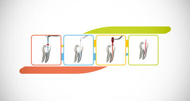 VDW Endo-System promises easy root canal therapy in four steps