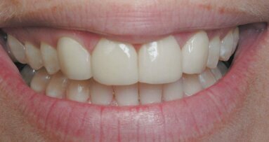 Έρχεται η «αναγέννηση» των δοντιών