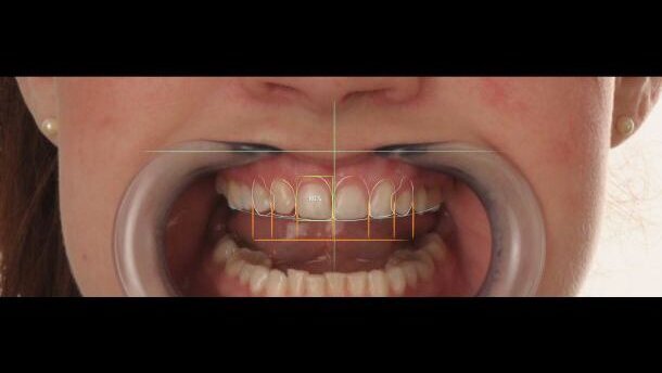 Digital Smile Design: “meer communicatievorm dan techniek”