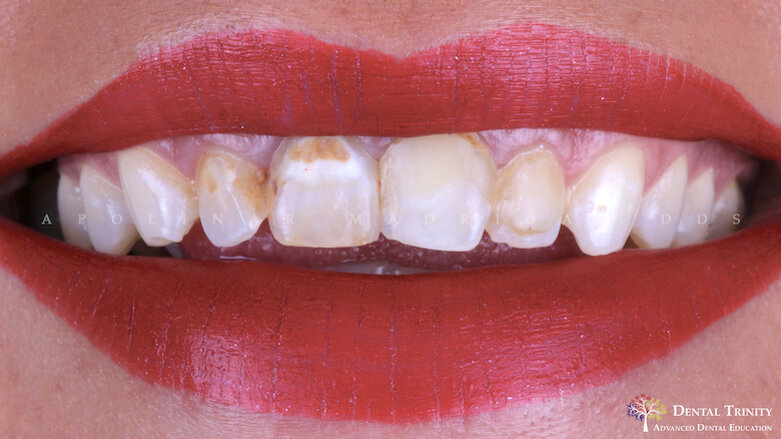 Carillas de Mínima Invasión