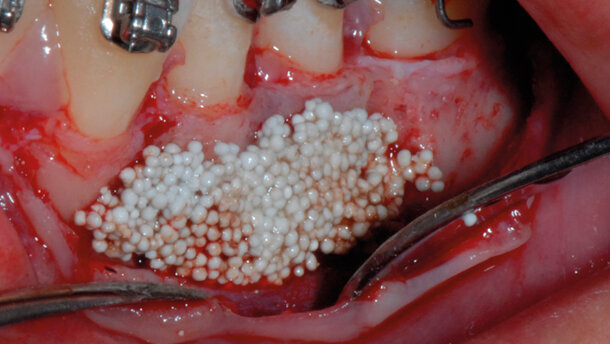 Utilizzo di un innovativo materiale da innesto nel movimento ortodontico parodontalmente accelerato