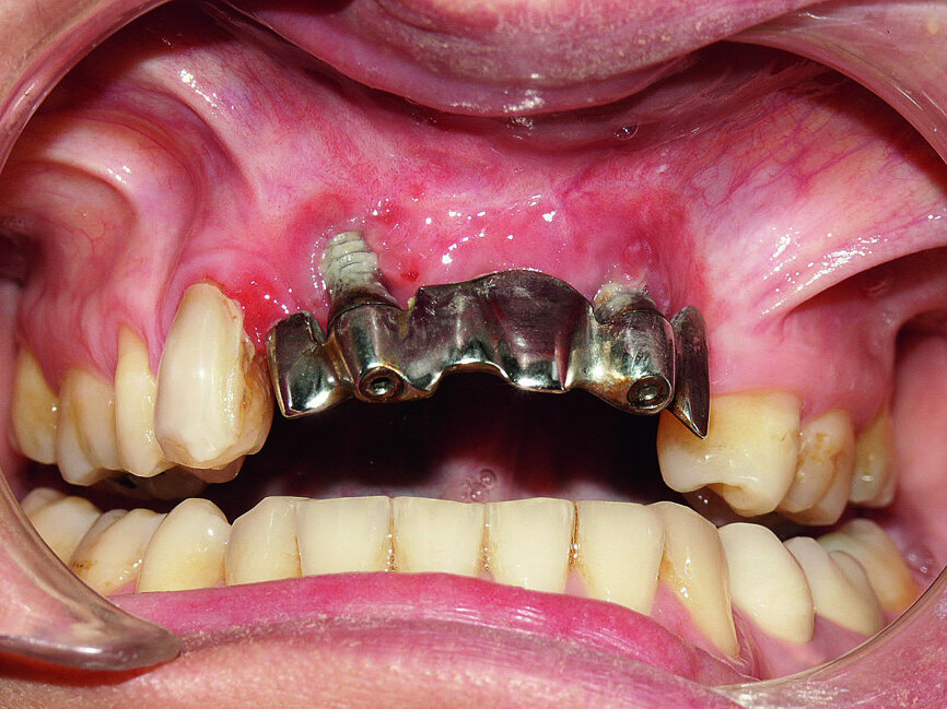 Fig. 3: Examination after three years revealed
a negative short-term prognosis for the implants owing to significant recession at the right implant and hyperplastic tissue.