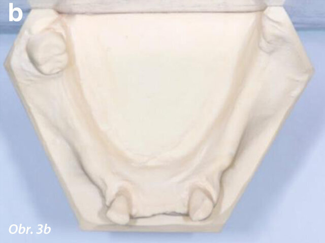 Frontální (a) a okluzální pohled (b) na studijní modely po extrakci zubů