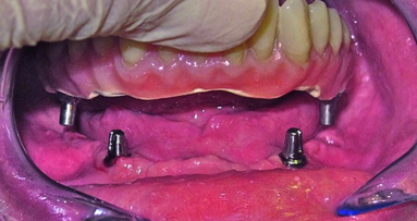 Prothèse totale fixe non métallique sur quatre implants SHORT®