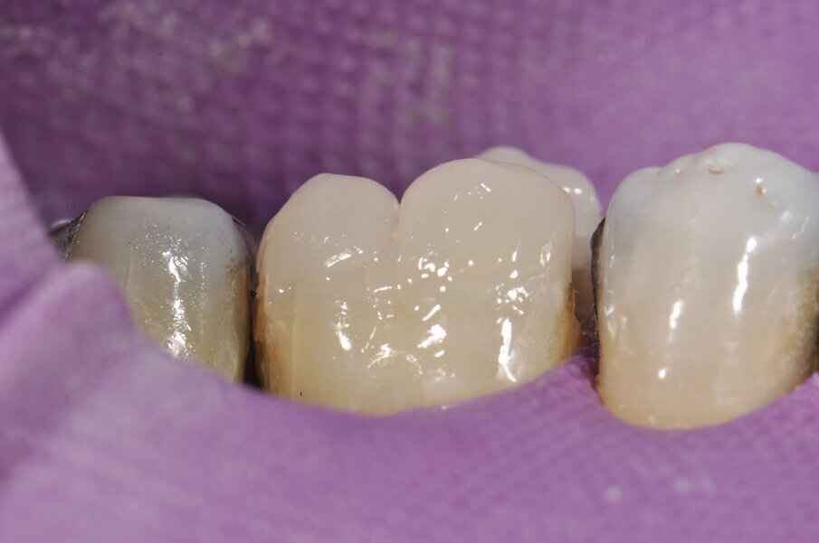 Fig. 6: Modelado de las paredes bucales y linguales de las cúspides.