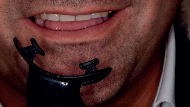 La concordance dei protocolli operativi domiciliari e professionali per il benessere del sorriso in un paziente che pratica sport agonistici: case report