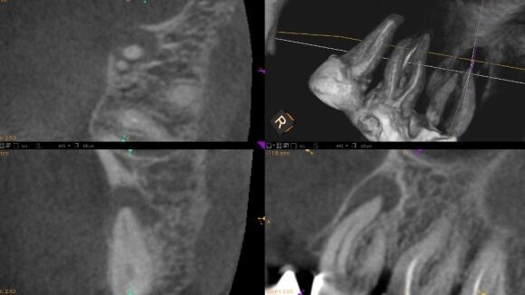 Precyzyjna ocena obecności, lokalizacji i rozmiaru zmian okołowierzchołkowych z wykorzystaniem CBCT