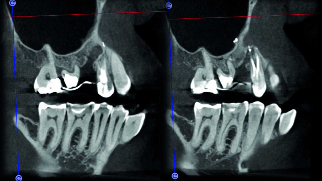 La technologie 3D dans le diagnostic et le traitement des maladies endodontiques