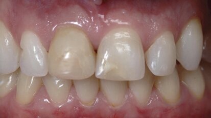 Estética y blanqueamiento dental en la era digital  (Capítulo 17)